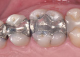 Mit Amalgam Mit Amalgam