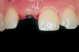 Implantat Implantat