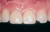 Implantat Implantat