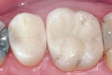 Ohne Amalgam Ohne Amalgam