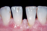 Veneers, Verblendschalen Veneers, Verblendschalen