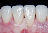 Veneers, Verblendschalen Veneers, Verblendschalen